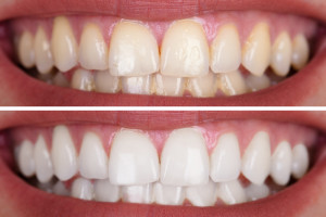 Woman's Teeth Before And After Whitening